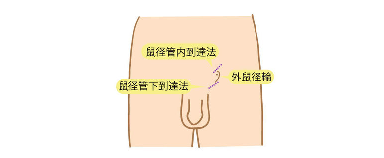 図１　鼠径管下到達法