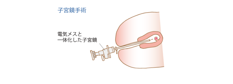 子宮鏡手術