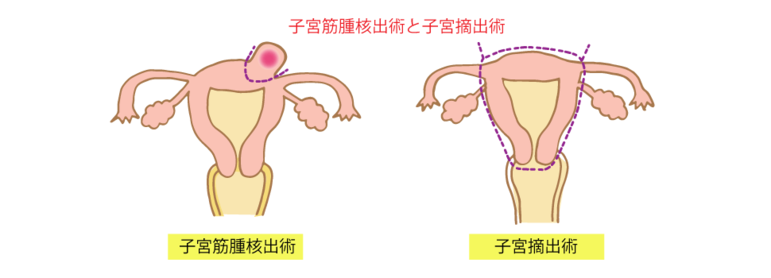 子宮筋腫核出術と子宮摘出術