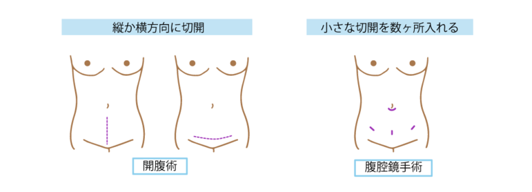 開腹術と腹腔鏡手術