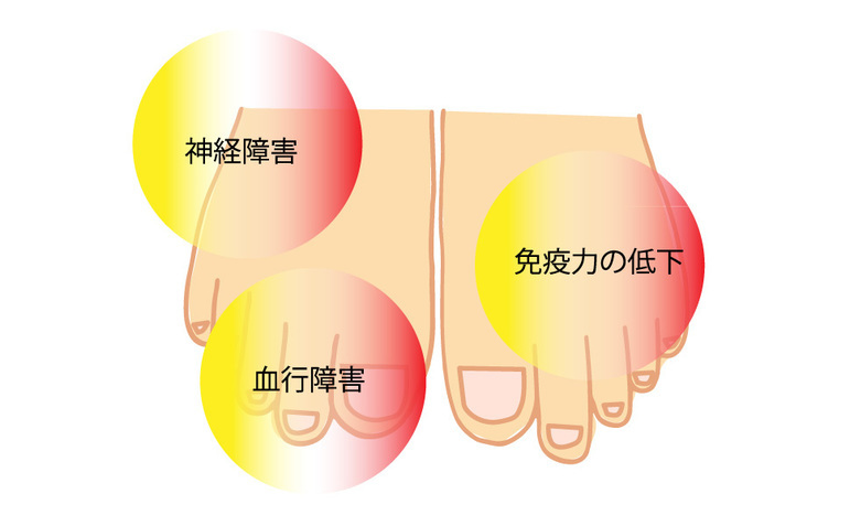 神経障害　血行障害　免疫力の低下