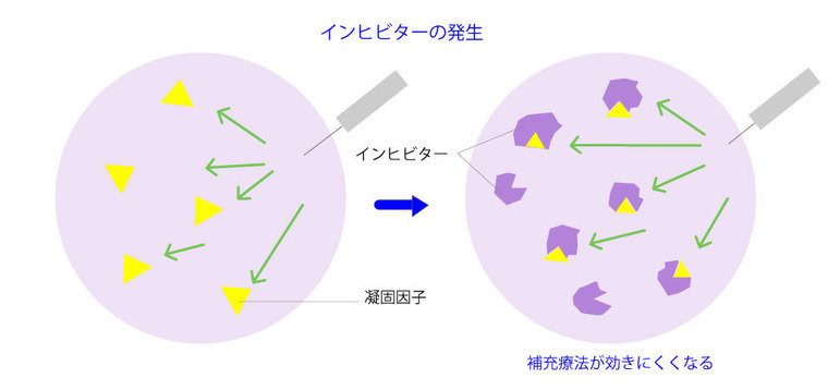 血友病インヒビターの発生