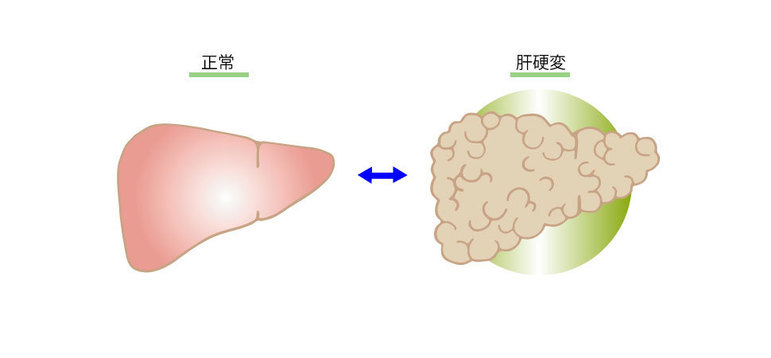 肝硬変が治る病気に どうして肝硬変が治るようになったのか メディカルノート 肝硬変が治る病気に どうして肝硬変が治るようになったのか メディカルノート