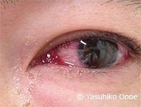 クラミジア封入体結膜炎