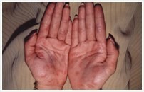 第2期の症状（丘疹性梅毒疹1）