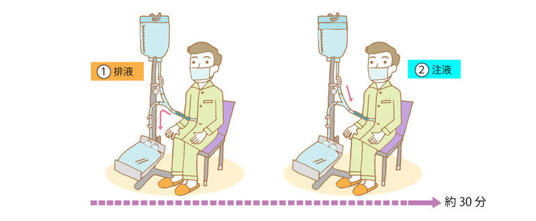 バック交換（排液と注液）