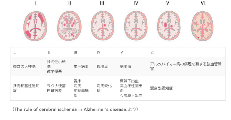 血管性認知症（Vd）の検査・診断は？ | メディカルノート