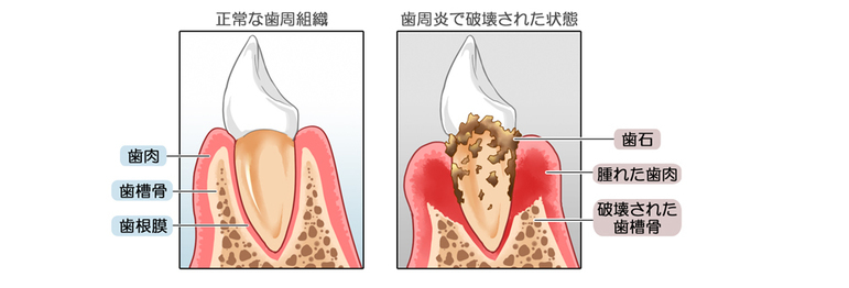 正常な歯周組織と歯周炎で破壊された歯周組織