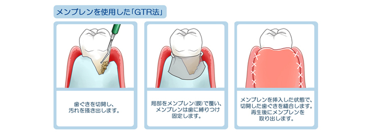 メンブレンを使用した「GTR法」