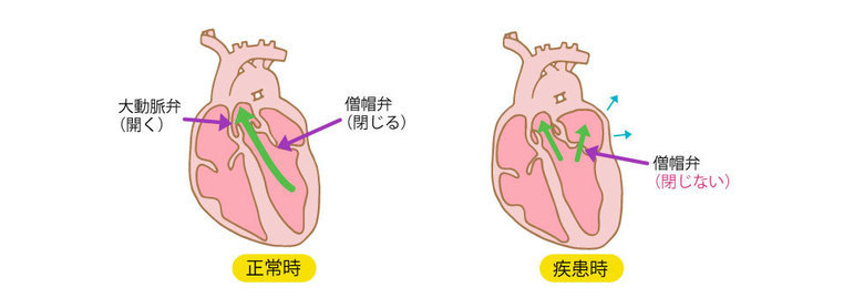 僧帽弁閉鎖不全症の仕組み