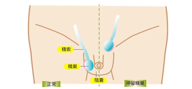 停留精巣とは？