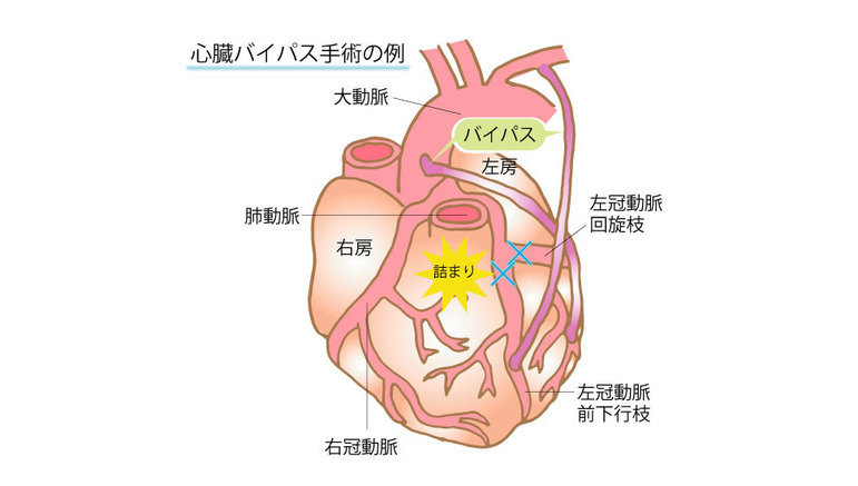 心臓バイパス手術の例