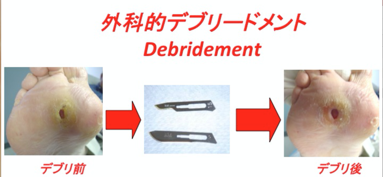外科的デブリードメント