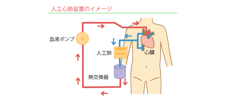 人工心肺装置のイメージ