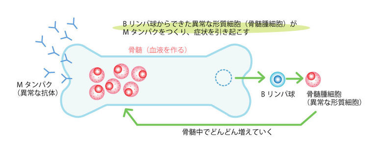 Bリンパ球が骨髄腫細胞に変化してMタンパクをつくります