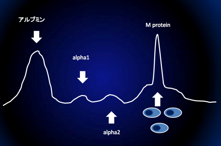 右のほうに急な山型があります。これはMタンパクがあることを示しています。