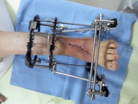 装具による固定、イリザロフ法