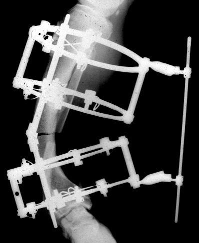 装具による固定、イリザロフ法（レントゲン）