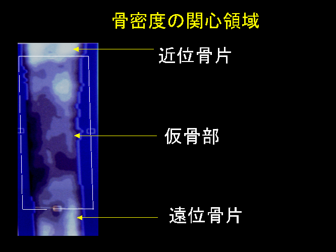 仮骨が徐々に出来ていく