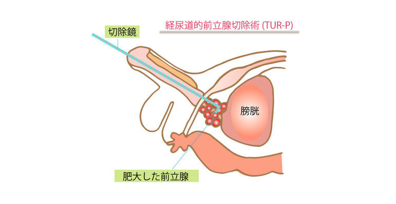 経尿道的前立腺切除術（TUR-P）
