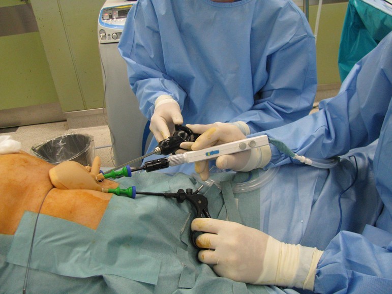 マルチポートによる単孔式腹腔鏡手術