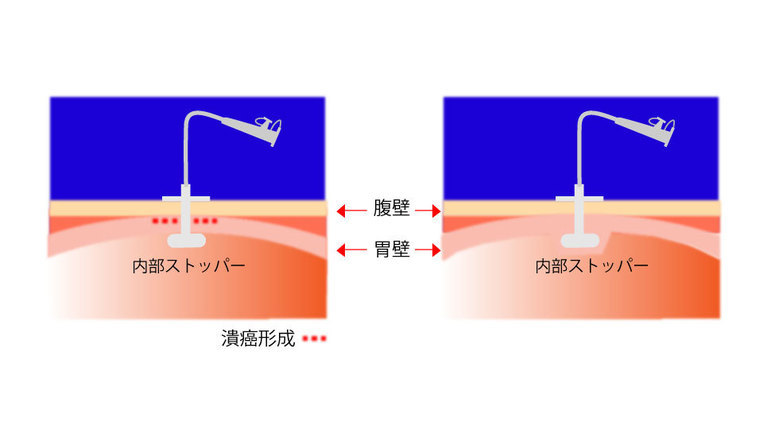 バンパー埋没症候群