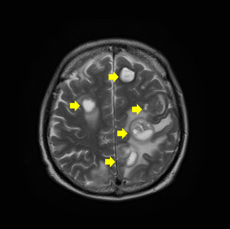 肺がんの脳転移MRI画像