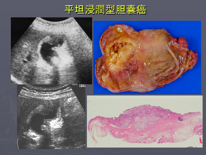 平坦浸潤型胆のうがん