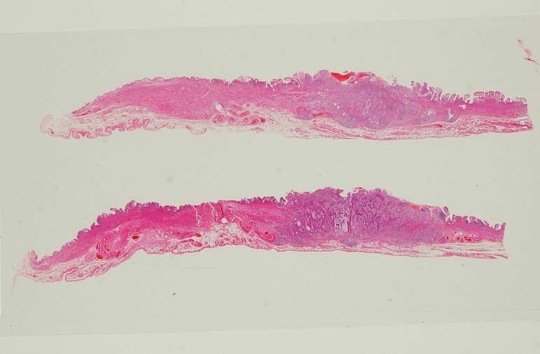 平坦浸潤型胆のうがん