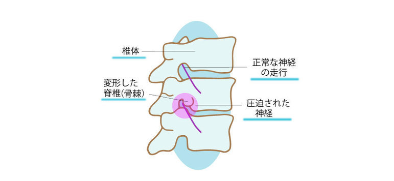 骨棘が形成される様子