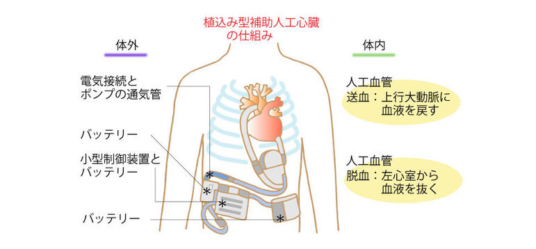 植込み型補助人工心臓の仕組み