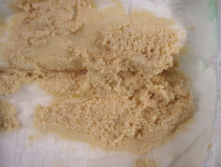 胆道閉鎖症の患者さんの便