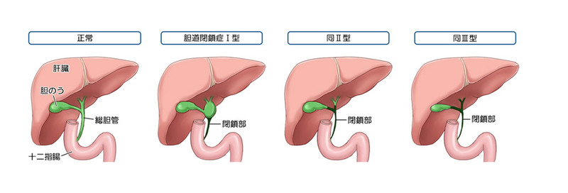胆道閉鎖症の分類