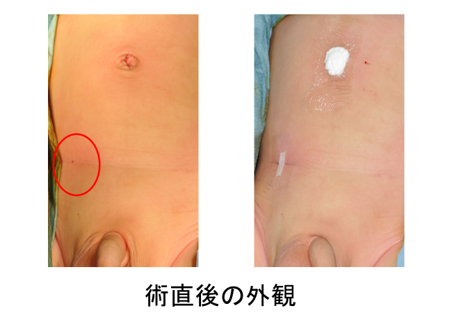 鼠径ヘルニア手術後