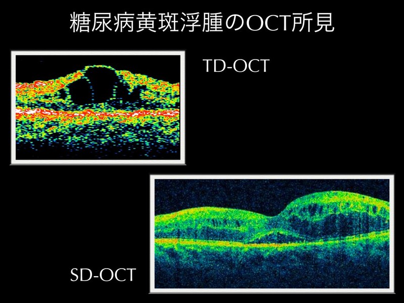 糖尿病網膜症の検査と最新治療―抗VEGF薬からレーザー治療、硝子