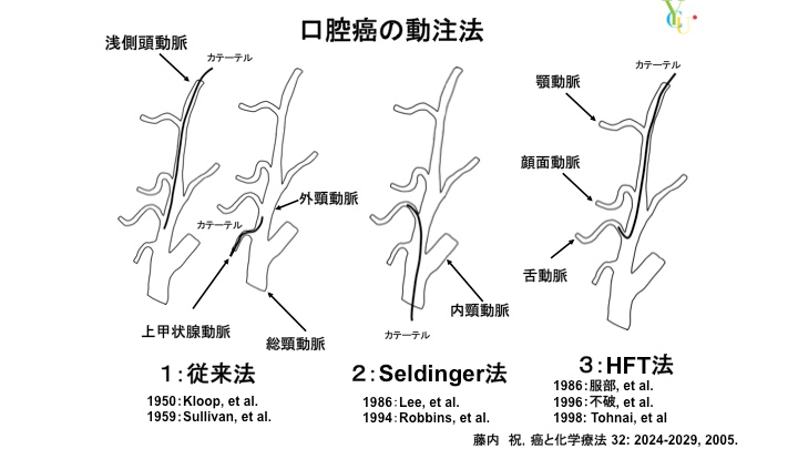 口腔がんの動注法