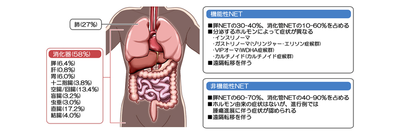 機能性神経内分泌腫瘍（NET）