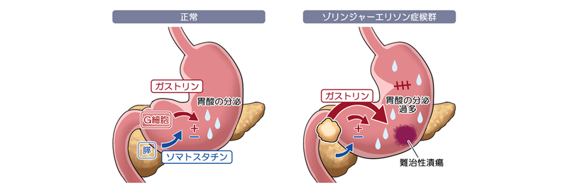 左：正常の胃酸分泌メカニズム、右：ゾリンジャー・エリソン症候群の胃酸分泌メカニズム