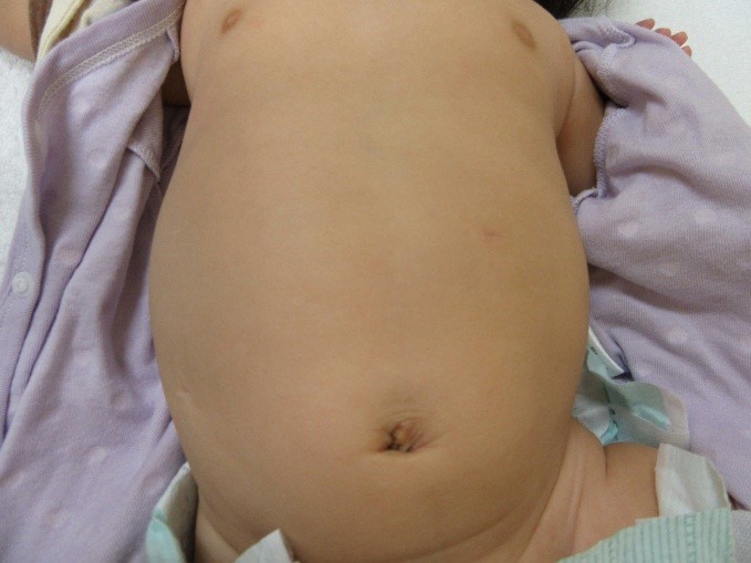 胆道閉鎖症　腹腔鏡