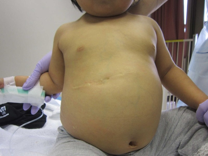 胆道閉鎖症　開腹