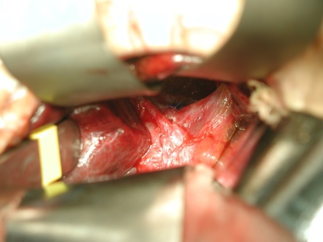 開腹時の肝門部の術野