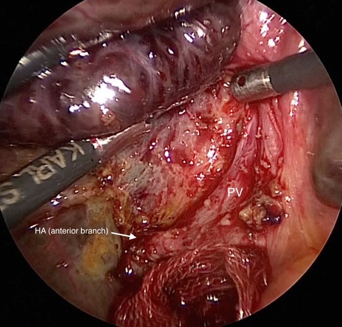 腹腔鏡下時の肝門部の術野