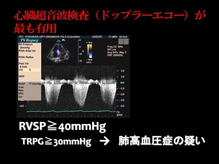 心臓超音波検査が最も有用