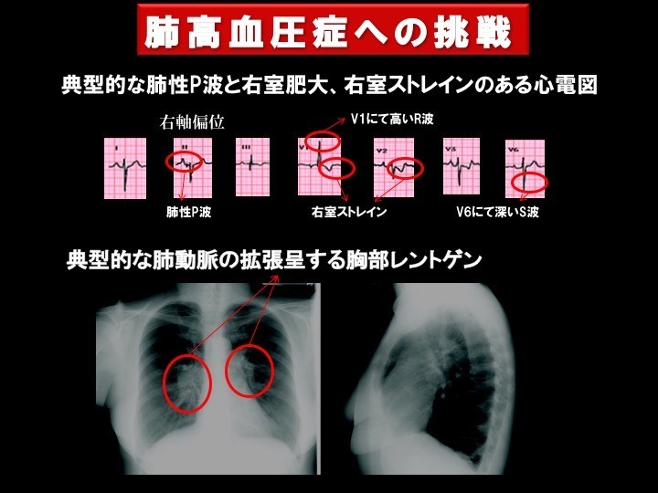 肺高血圧症への挑戦