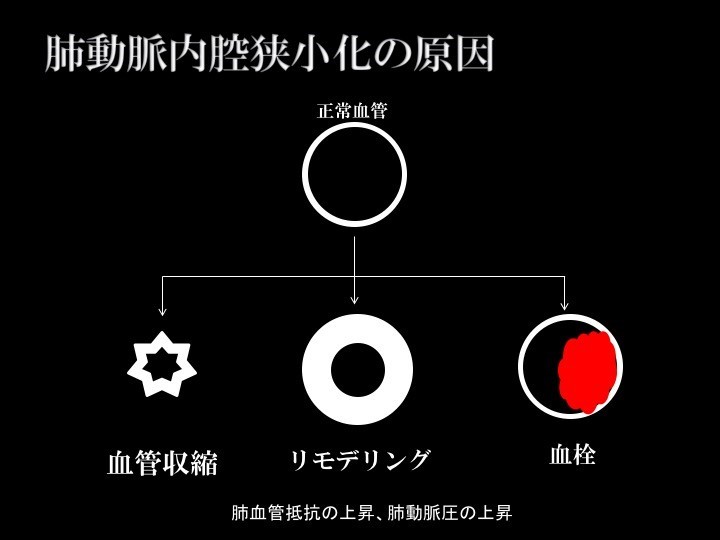 肺動脈内腔狭小化の原因