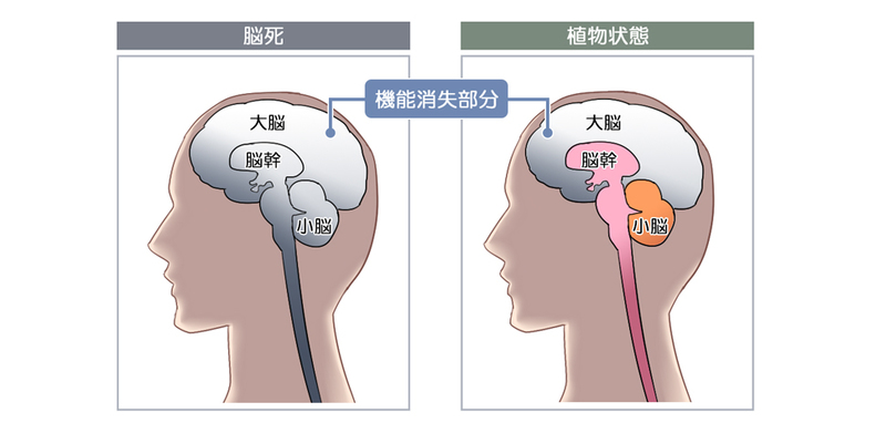 脳死と植物状態の違い