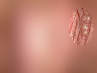 性器ヘルペス再発(男性)