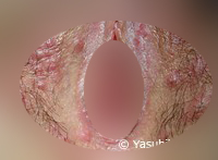 性器ヘルペス初感染（女性）