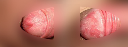 性器カンジダ症　男性の症状