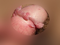 鬼頭冠状溝周囲